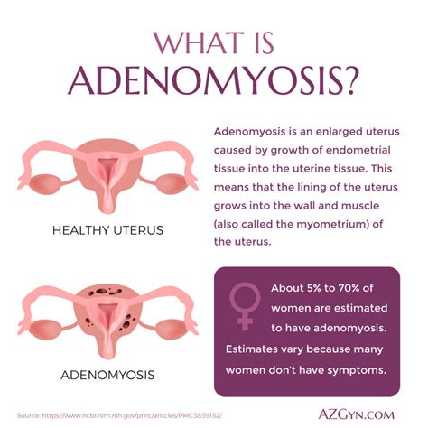 Adenomyosis 醫學